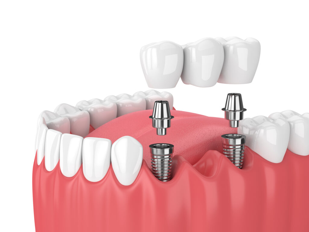 Dental implants in Traverse City, MI