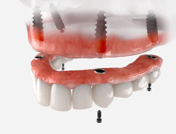 Dentures vs. Implants: Which One Lets You Eat in Traverse City, MI