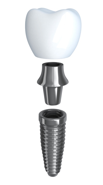 Single dental implant