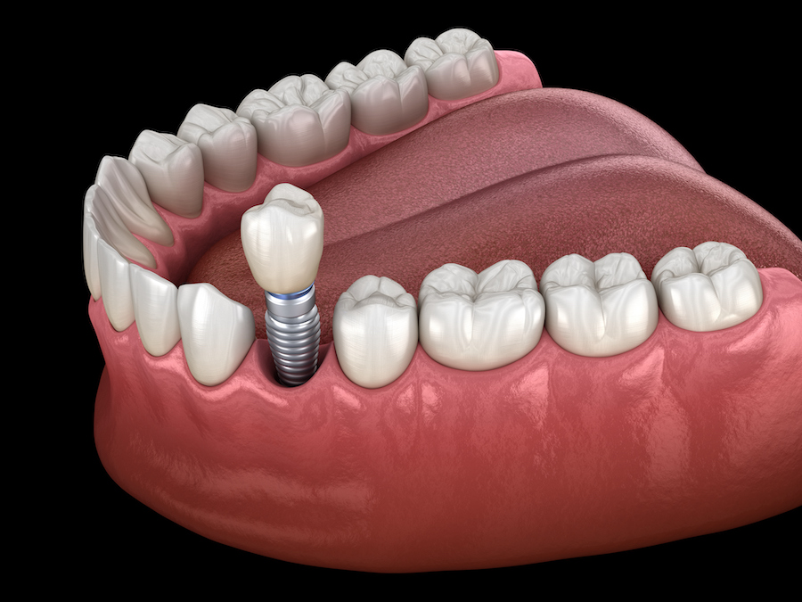 Are Dental Implants Worth the Investment? A Guide to Long-Term Value
